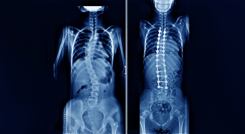 Xray Of A Person With Scoliosis